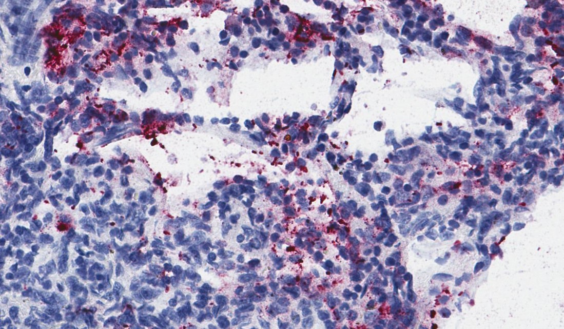 Immunostaining by using a select gram-negative bacterial immunohistochemistry (IHC) assay that detects K. pneumoniae