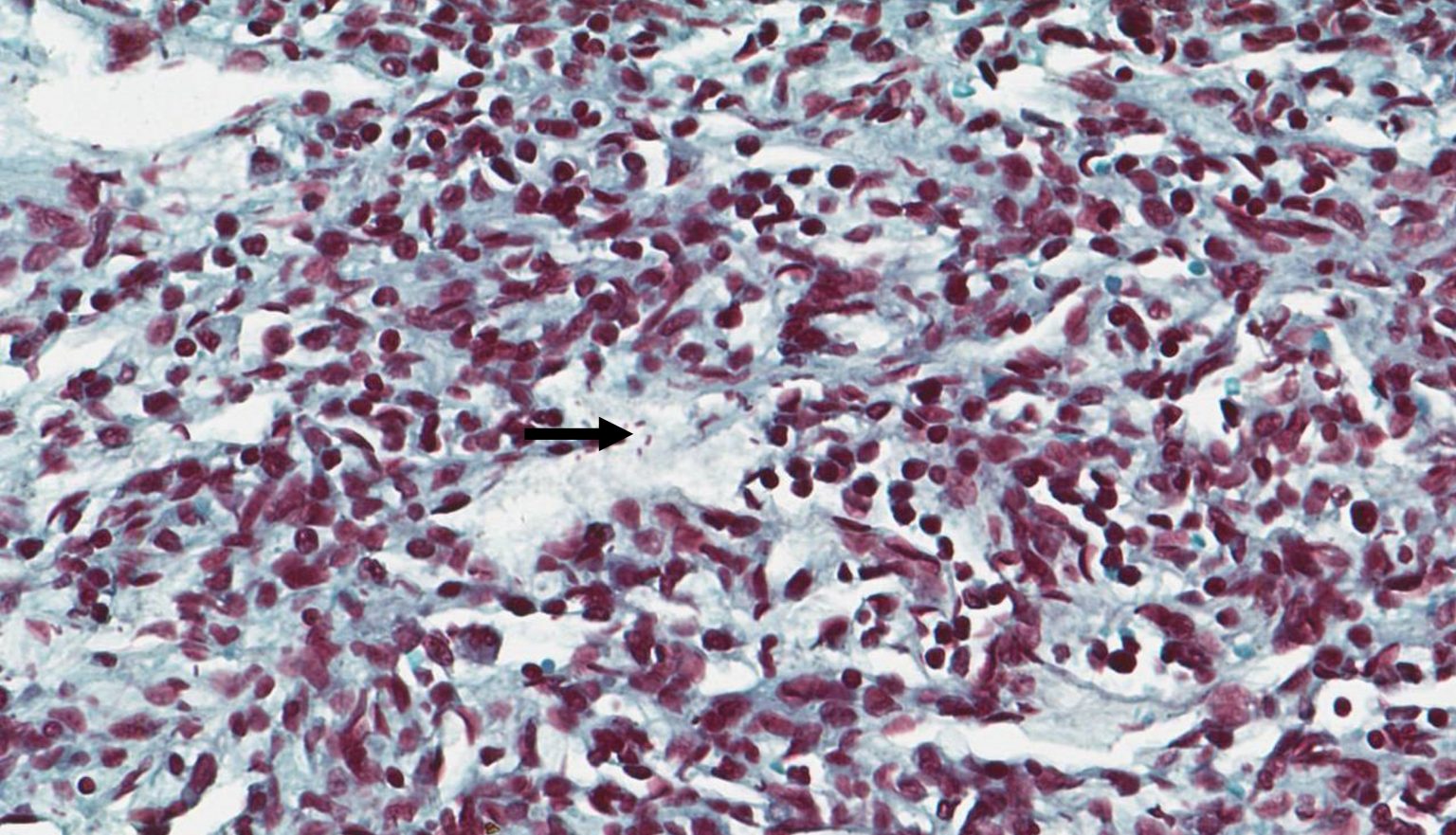 Acute aspiration with gram-negative bacterial rods