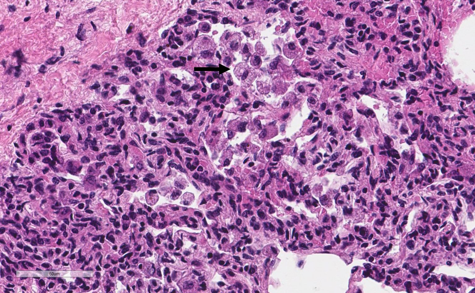 Lung showing intraalveolar microphages (arrow)