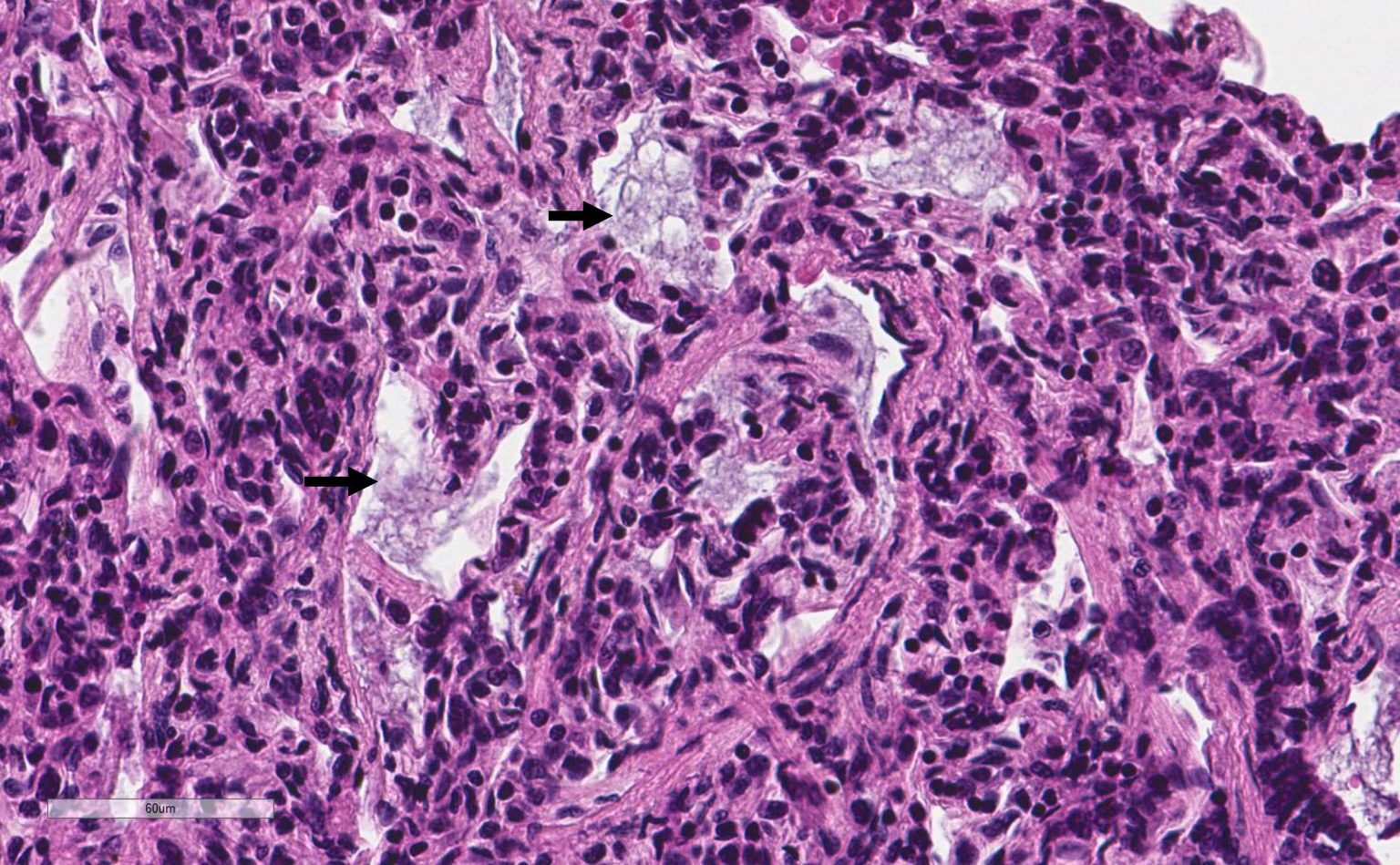 Lung showing acute aspiration (arrows) with interstitial pneumonitis