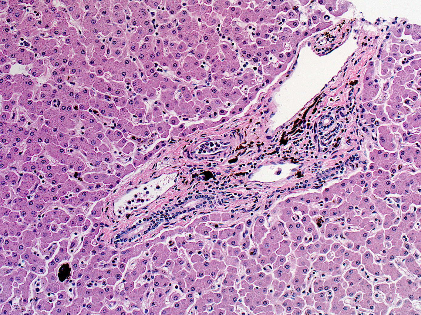 Abundant malaria pigment (brown) in the liver