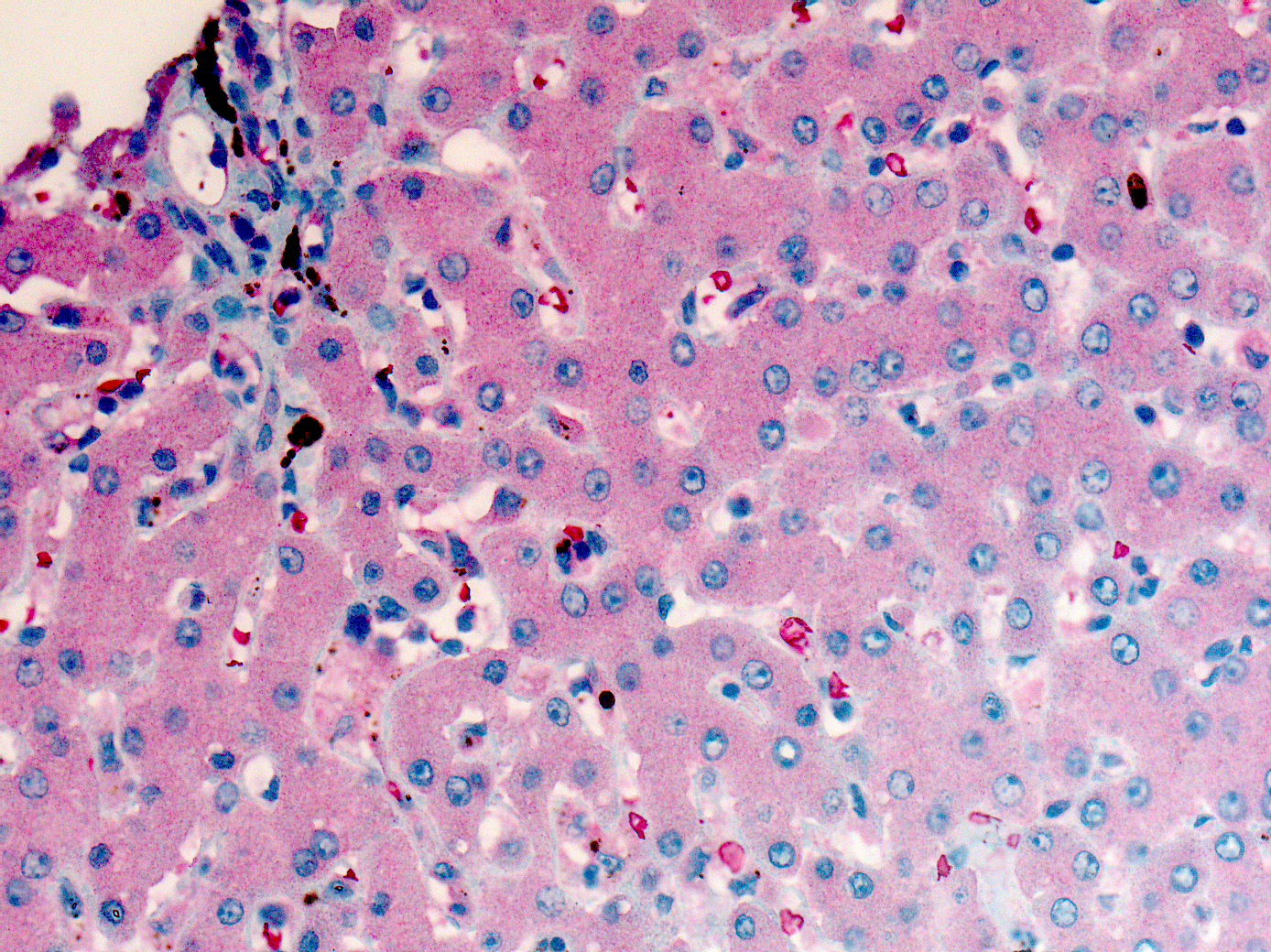 Plasmodium falciparum malaria parasites staining by immunohistochemistry in the liver