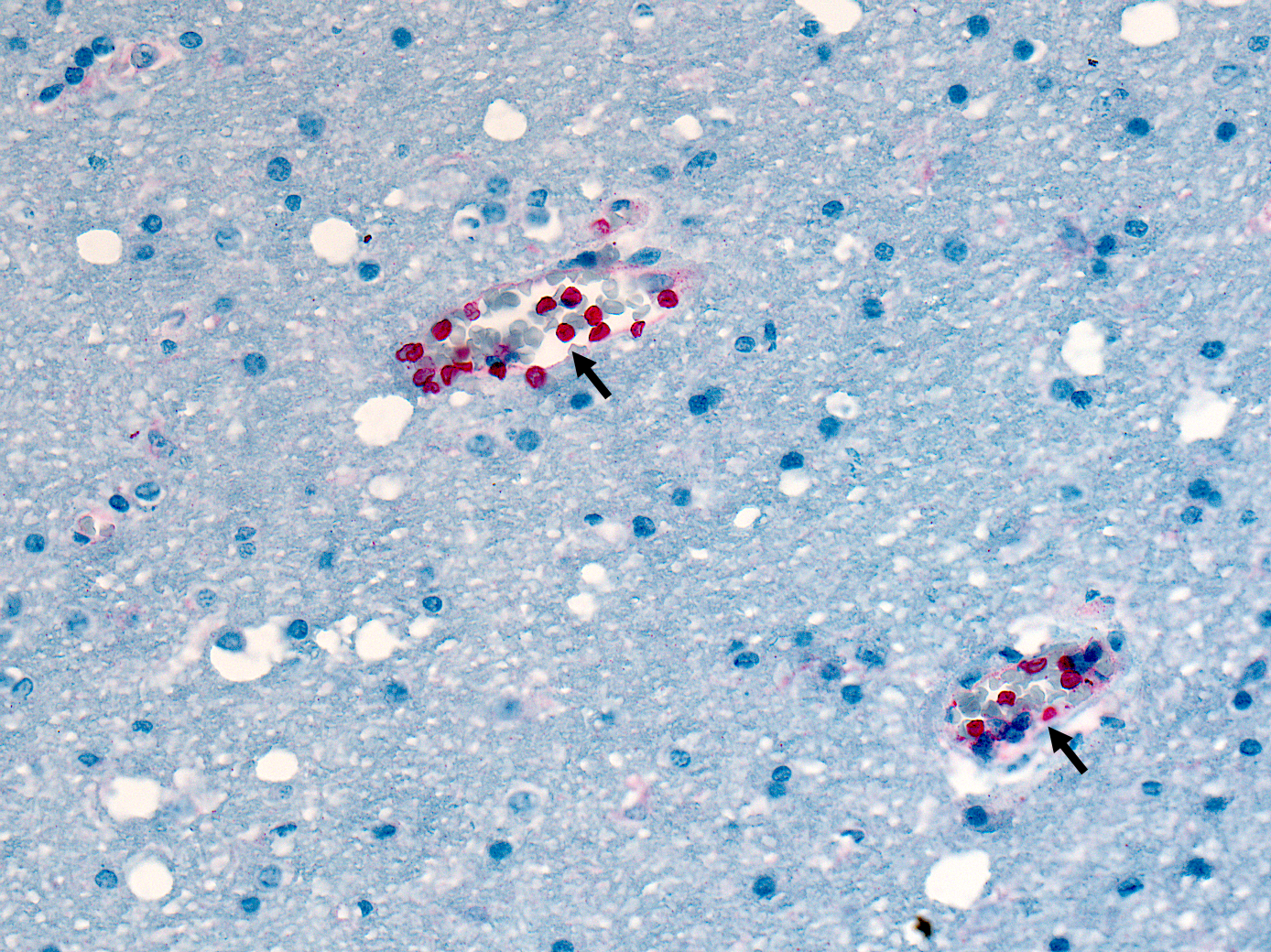 Plasmodium falciparum staining by immunohistochemistry within red blood cells in small blood vessels in the brain