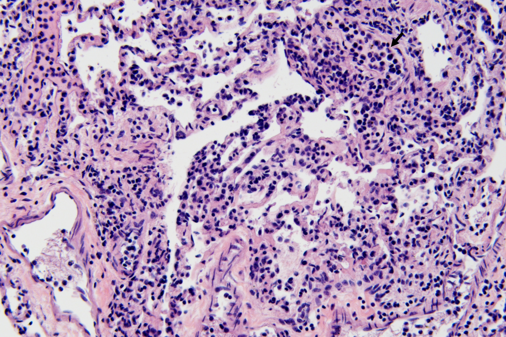 Increased leukocytes within a blood vessel in the lung (arrow)
