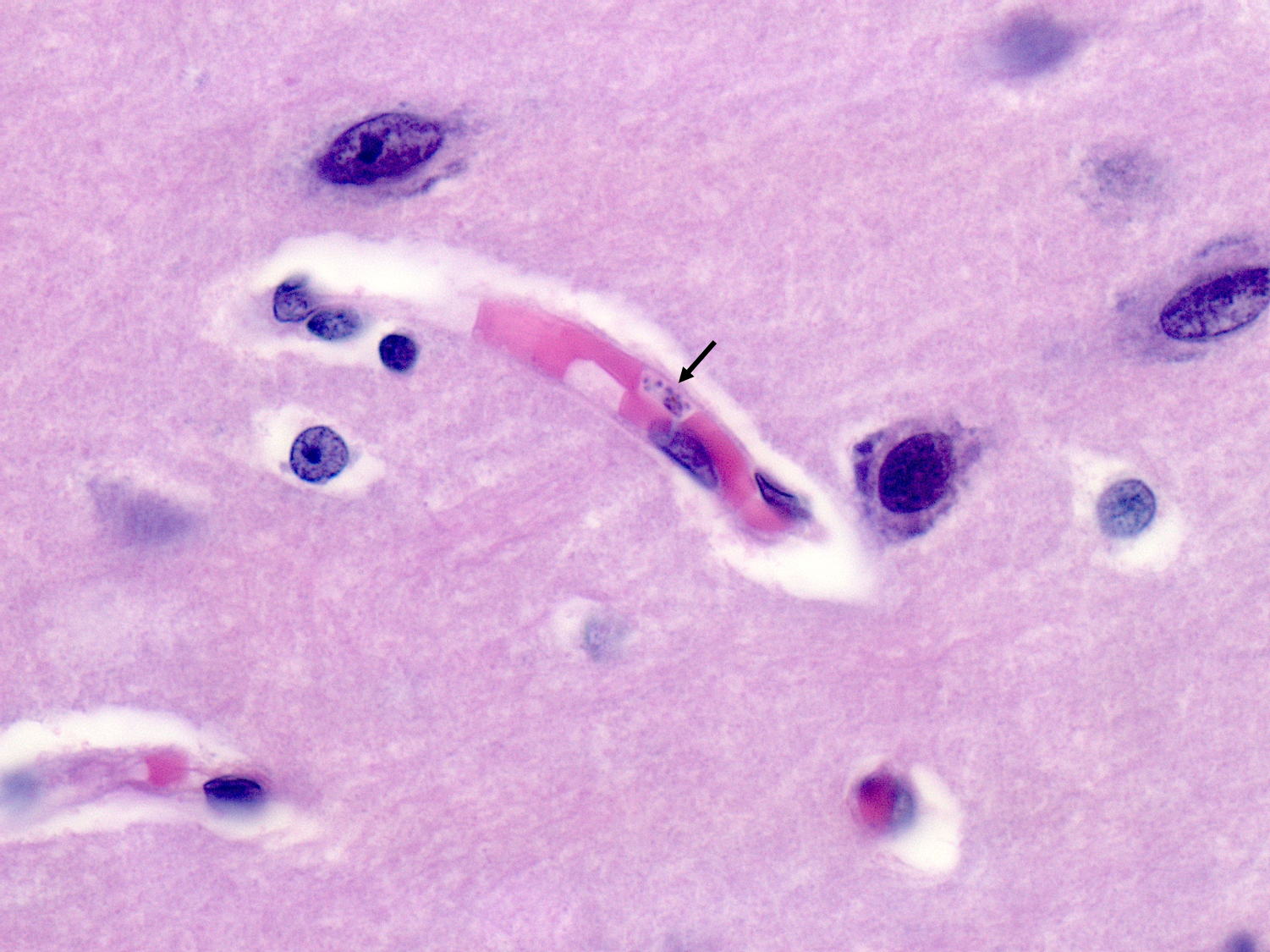 Malaria parasites within a red blood cell in the brain (arrow)