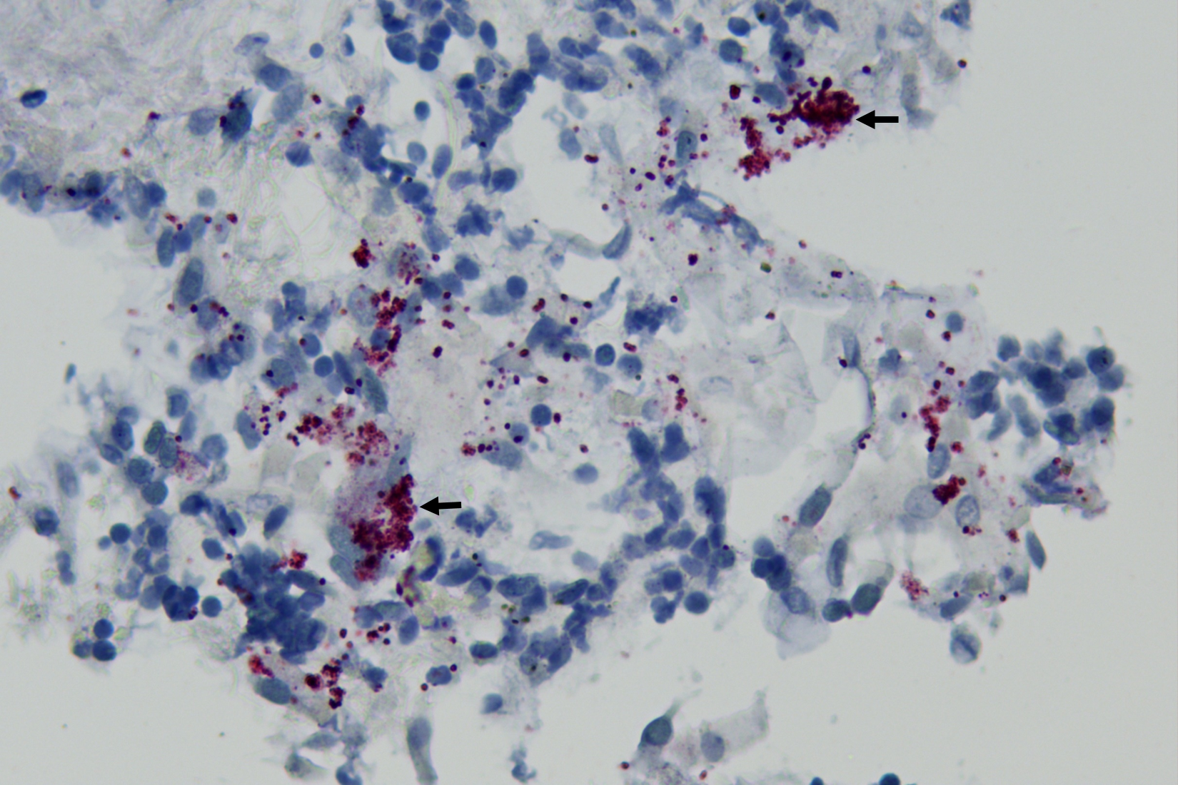 Clusters of Streptococcus bacteria seen in the lung by immunohistochemistry (arrows)